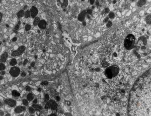 F,3y. | extracellular cholestasis- reduced microvilli in primary bile duct F,3y. | extracellular cholestasis- reduced microvilli in primary bile duct